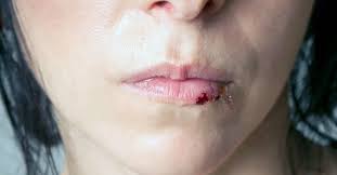 split lip causes treatments and home
