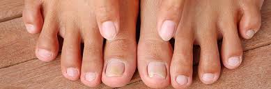 types of fungal nail infection
