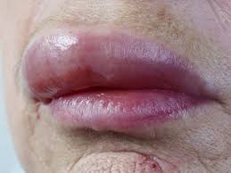 swollen lips causes and treatment