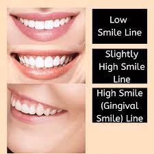 what is the gingival smile line