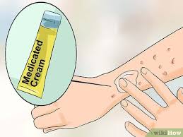 how to identify an hiv rash 15 steps