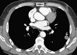 metastatic myxoid liposarcomas imaging