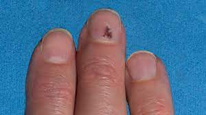 my nail or is it melanoma