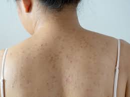 how to treat hyperpigmentation on the body