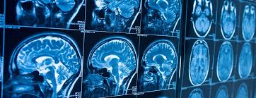 Image result for icd-10 code for brain cancer
