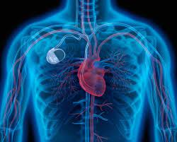 Implantarea stimulatorului cardiac: Indicații, procedură, întrebări frecvente | MedLife