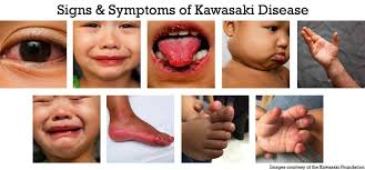 First draft for internal cdc review. Kawasaki Disease In Infants Young Children Healthychildren Org