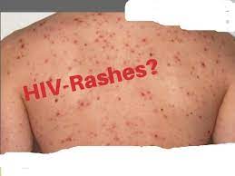 skin rash hiv aids clinic hyderabad
