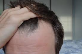 scalp acne and can it lead to hair loss