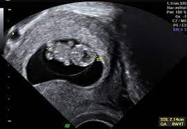 Ultraschall, entwicklung, anzeichen & symptome. Schwangerschaft Praxis Dr Seidenfus