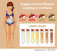 liver disease leading to cirrhosis
