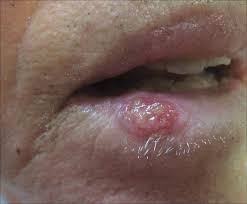 eroded plaque on the lower lip mdedge