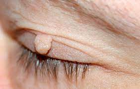 removing skin s on eyelids