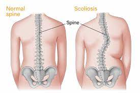 scoliosis treatment know your