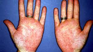 Palmar erythema causes the skin around the palms and fingers to become red and warm. Palmar Erythema Symptoms Causes Treatment And More