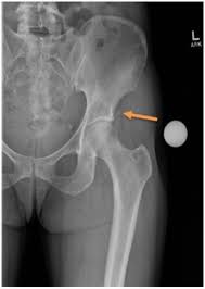 Calcific Tendonitis Calcific Tendonitis | Causes | Best Treatment Options | Homeopathic | Best Homeopathic Doctor in Pakistan | Dr Qaisar Ahmed MD, DHMS