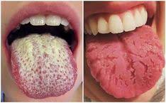 Use these ingredients for how to clean your white tongue naturally.normally, the tongue should be pink with a hint of white on it. 16 Best Tongue Health Ideas Tongue Health Tongue Tongue Scraper
