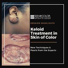 keloid treatment in skin of color new