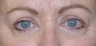 upper eyelid surgery for hooded eyes