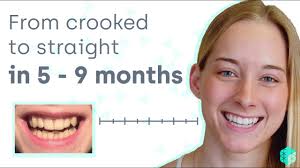 The first step is to provide the structural support to align the teeth in the upper jaw. How To Straighten Crooked Teeth Easily And Affordably Without Metal Braces Youtube