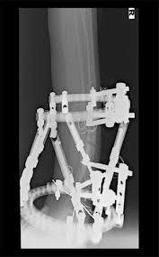 osteotomy and application of tsf