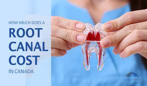 Not all insurance plans cover every aspect of dental care. All About Root Canal Cost Signs And Treatment In Canada