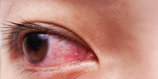 eye infection treatment in dubai