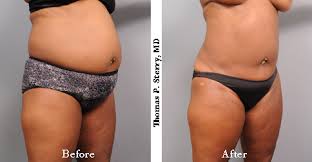 liposuction today in may