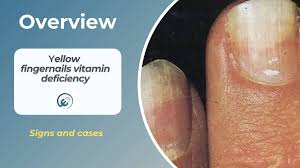 yellow fingernails vitamin deficiency