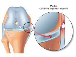 al collateral ligament knee injury
