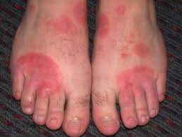 A diaper rash is characterized by inflamed skin and a rash in the diaper area, which includes the here are some home remedies for treating a diaper rash. Shoe Contact Dermatitis Dermnet Nz