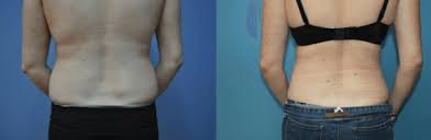 how much does liposuction cost boston
