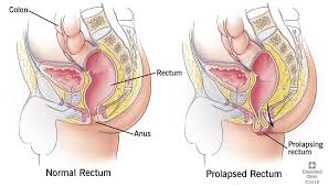 Information about hemorrhoids and their causes such as straining during a bowel movement, pregnancy, liver disease, and conditions that cause increased pressure in the hemorrhoid veins. Rectal Prolapse Treatment Diagnosis Causes Symptoms