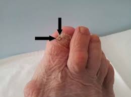 treatment subungual melanoma in foot