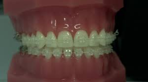 Braces straighten teeth because they do two very important things: Adult Braces More People Paying Thousands For Straighter Teeth Bbc News