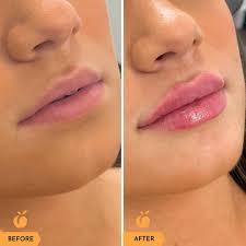 lip shape enhancement peach skin