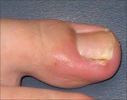 ingrown great toenail