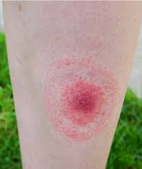 lyme other tick borne diseases