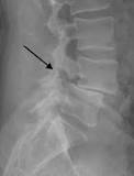 Image result for icd 10 code for spondylolisthesis unspecified