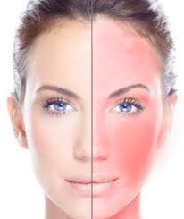 skin care for rosacea leicester laser
