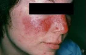 lupus and your skin foothill