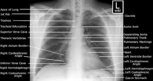 By julian dobranowski, md, frcpc. A Chest X Ray Anatomy Johnryanfuentes