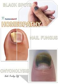 homeopathy cines for nail fungus