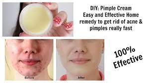 diy pimple cream 100 effective acne