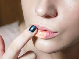 lip licker s dermais causes