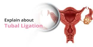 what is tubal ligation surgery birla