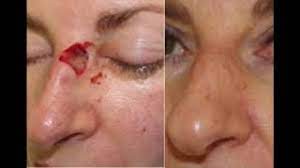 skin reconstruction after mohs surgery