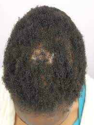 hair breakage in black women not to be