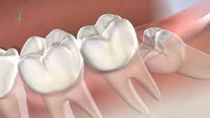 wisdom tooth extractions