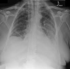 Pleural eﬀusions can loculate as a result of adhesions. Loculated Pleural Effusion On Cxr Radiology Case Radiopaedia Org